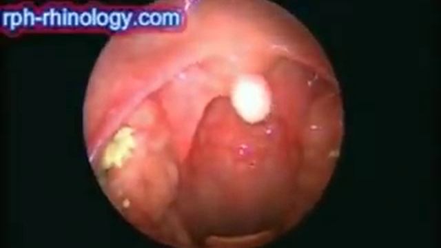 Tonsil Follicle смотреть онлайн