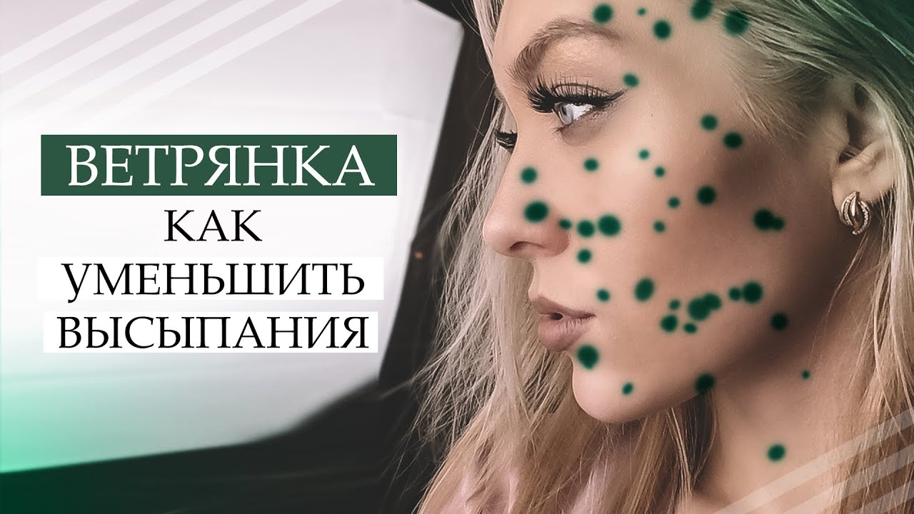 ВЕТРЯНКА У ВЗРОСЛЫХ / КАК Я УМЕНЬШИЛА ВЫСЫПАНИЯ И БЫСТРО ВЫЛЕЧИЛАСЬ