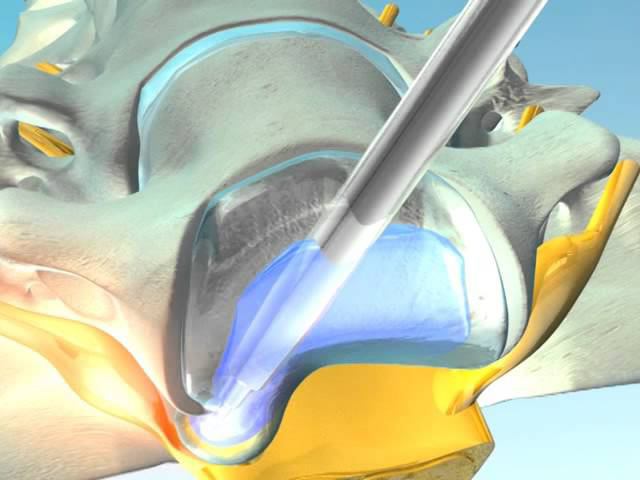 Впервые в России! Эндоскопическое удаление грыжи шеи CESSYS! смотреть онлайн