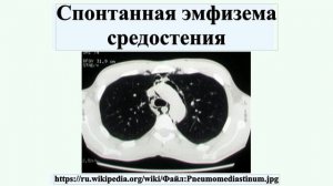 Спонтанная эмфизема средостения