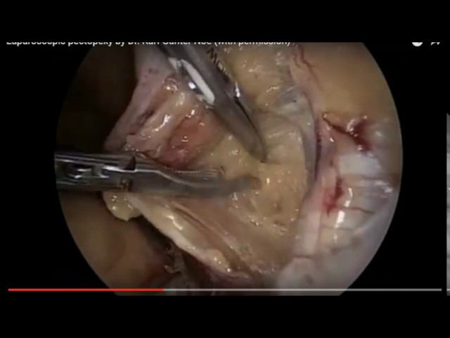 laparoscopic retrovesical colpopectinopexy vs pectopexy смотреть онлайн