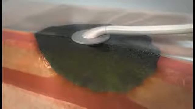 Заживление ран с помощью vac терапии смотреть онлайн