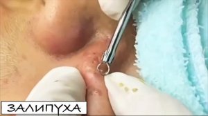 ПРЫЩИ 😍 ПРЫЩИ ВЫДАВЛИВАНИЕ 😍 ПОДБОРКА ВЫДАВЛИВАНИЕ ПРЫЩЕЙ #прыщи #acne #asmr