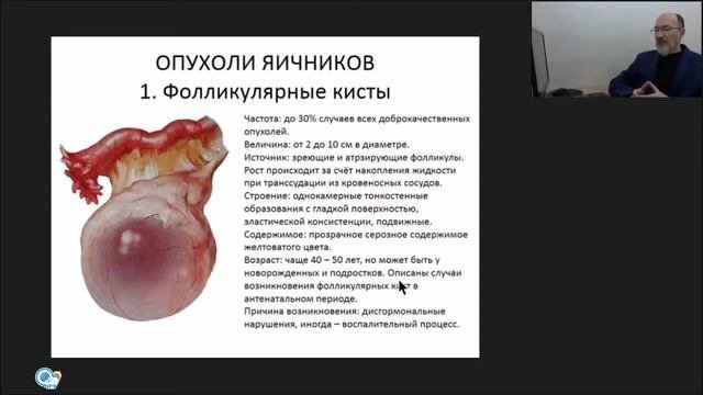 Опухоли и опухолевидные образования яичников. Часть первая.