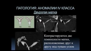 Богданова Е.О.«КТ- гистеросальпингография в диагностике причин бесплодия»