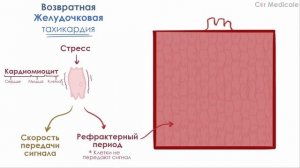 Желудочковая тахикардия