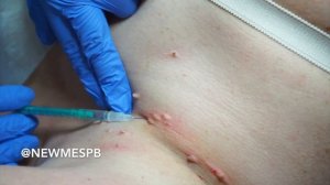 Лазерное удаление папиллом. Избавиться от папиллом навсегда!