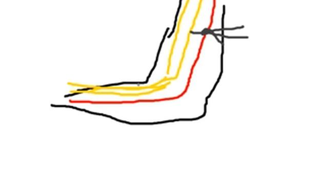 Способы остановки наружного кровотечения смотреть онлайн