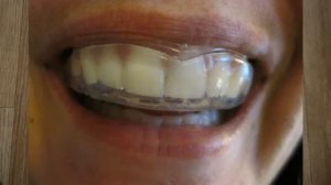 БРУКСИЗМ! СКРЕЖЕТ ЗУБАМИ как себе помочь