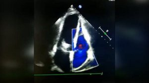 93. Констриктивный перикардит.