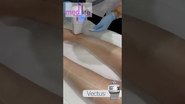 Antalya Vectus diod ince tüyler için lazer epilasyon