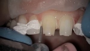 Препарирование резцов ч.1