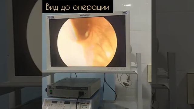 Эндоскопическая септоконхопластика.Искривление перегородки носа.Лечение.Ташкент.Септопластика.