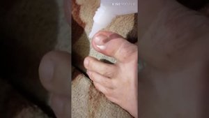 Как удалить вросший ноготь