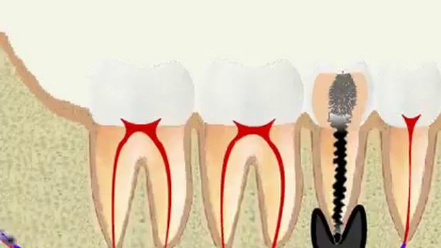 стадии периодонтита смотреть онлайн