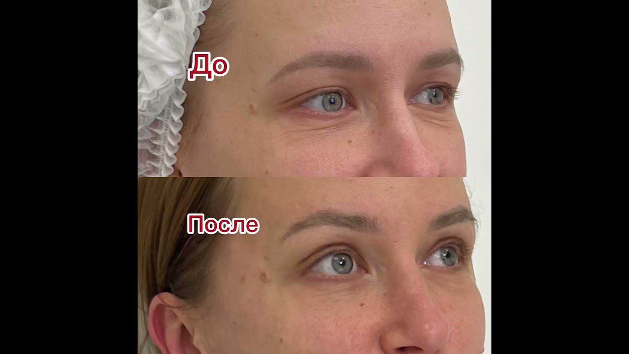 Омоложение зоны вокруг глаз. #врачкосметолог
