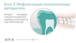 Лечение кариеса методом инфильтрации.