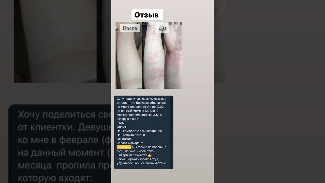 ТРИГЕЛЬМ отзыв