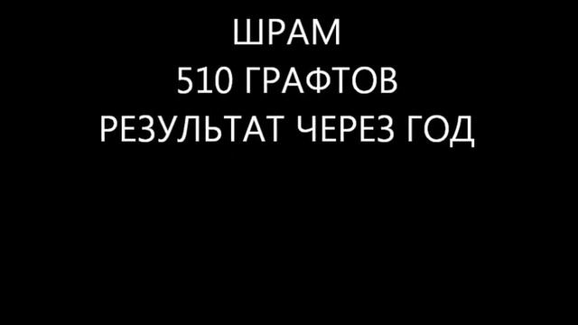 Бесшовная пересадка волос