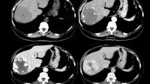 GIT radiology (hepatic imaging) | Prof. Mamdouh Mahfouz