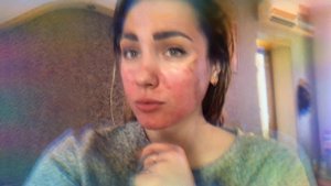 ПИЛИНГ ДЖЕССНЕРА/ ВОССТАНОВЛЕНИЕ