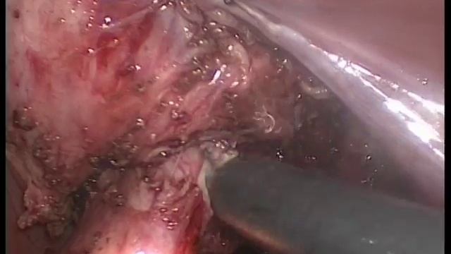 Удаление урогенитального синуса Лапароскопия Цистоскопия смотреть онлайн