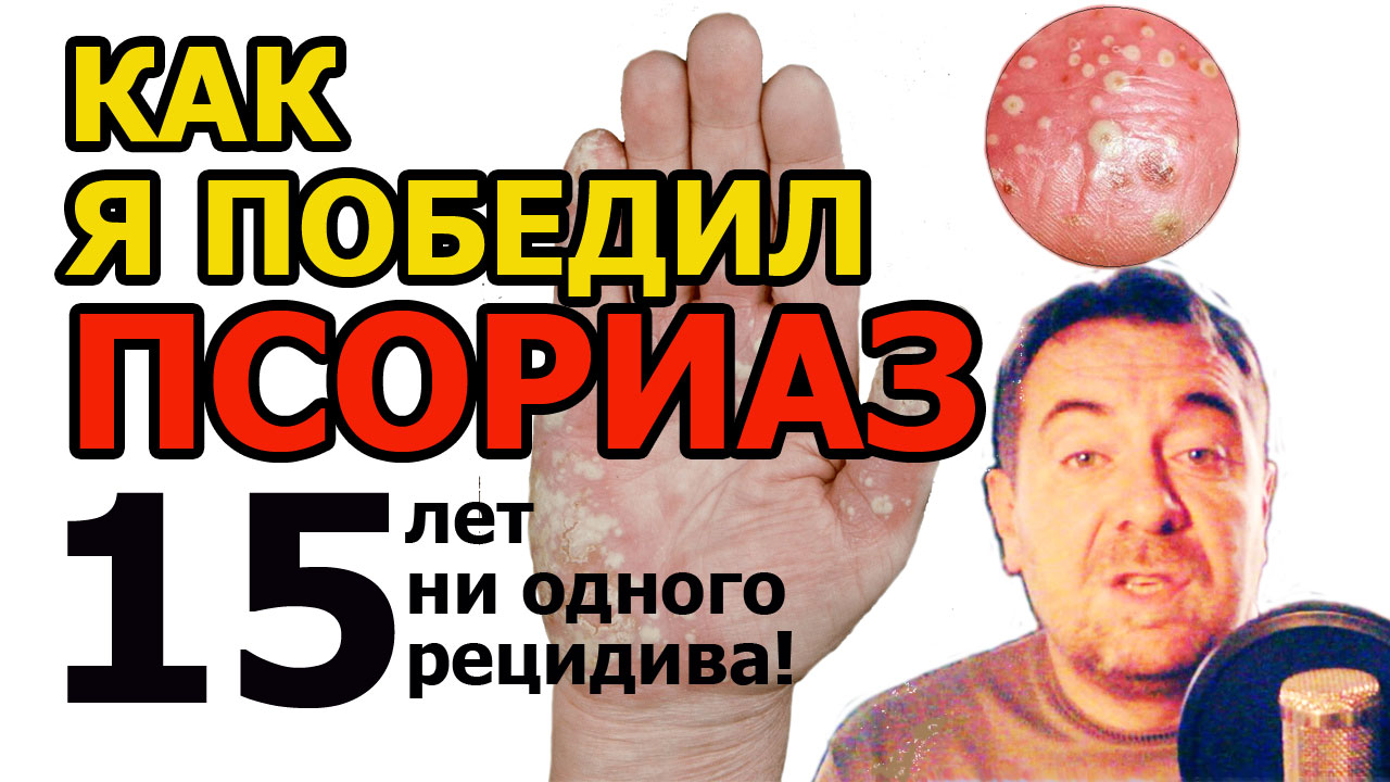 Как я победил ПСОРИАЗ: личный опыт. Мази, таблетки и нервы!
