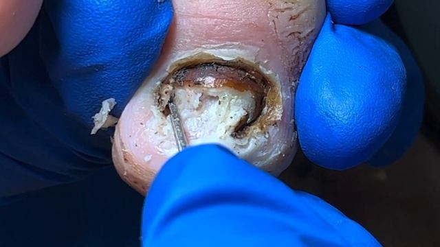 It’s so stress-relieving! Remove all bad nails!【Xue Yidao Pedicure】 смотреть онлайн