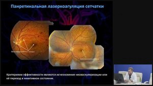 Патология органа зрения при сахарном диабете. Часть2.mp4