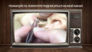 Выдавливание чёрных точек НОВОЕ! Удаление чёрных точек за ухом  Чистка лица  Прыщи   выдавливание01