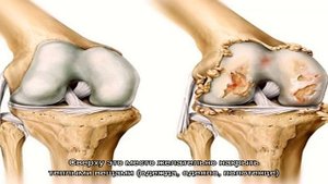 Как лечить тазобедренный сустав в домашних условиях