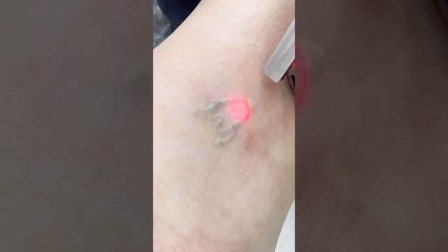 Удаление мини-тату РАКЕТА  ✅ #tattoo #удалениетату | студия  "Битый Небитого" +79312787373