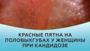 Красные пятна на половых губах при кандидозе