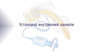 Трахеостомические трубки Portex, Ютипадо: установка внутренних канюль, правила эксплуатации