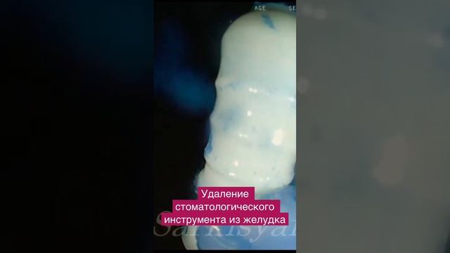 Что делать если проглотил инструмент у стоматолога? Удаление предмета из желудка