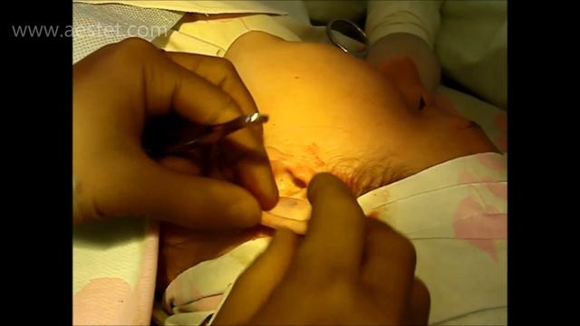 Односторонняя отопластика // Хирург Алексей Дужий // Otoplasty One Ear // Operation / Dr. Duzhy