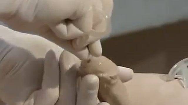 Установка и использование катетера Фолея смотреть онлайн