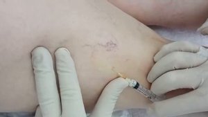 Примамед, Склеротерапия-Лечение варикоза уколами.