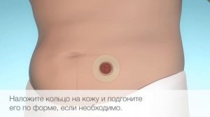 Защитное кольцо для стомы Brava (Coloplast), защита кожи вокруг стомы.