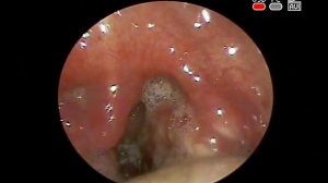 Когда болит #горло Диагностика лечение #ангины в КЛИНИКА ОБРАЗЦОВА #ЛОР врач