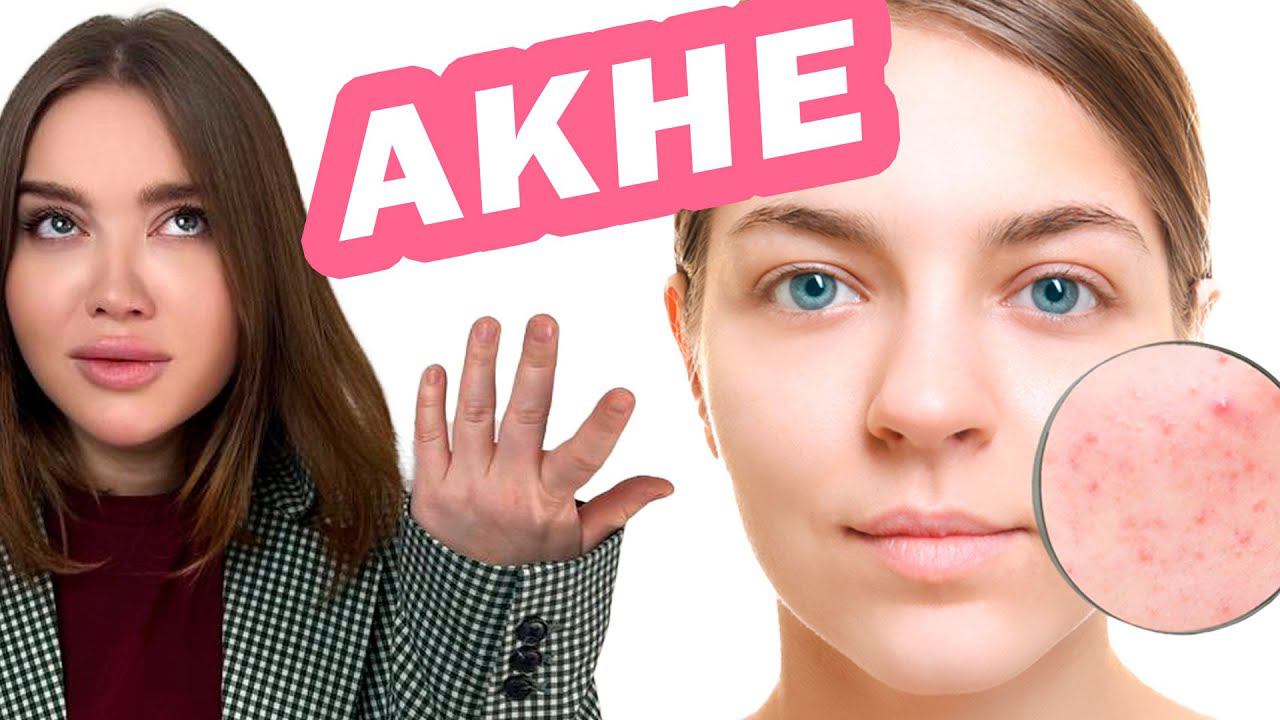 АКНЕ изучение проблемы! (Лекция 11-12 из марафона по лечению АКНЕ)