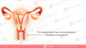 Китайские тампоны  Принцип действия