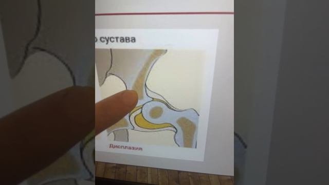 1 часть Дисплазия ТБС