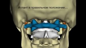 Коррекция атланта, первого шейного позвонка