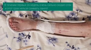 Лангет / тутор сразу после снятия апарата Илизарова