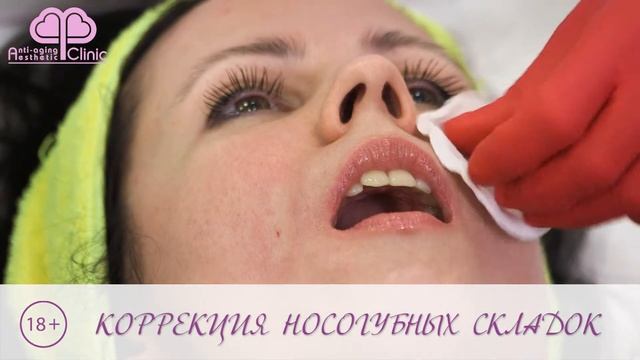 коррекция носогубных складок