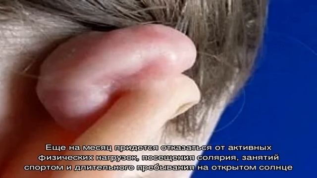 Как проходит реабилитация после отопластики смотреть онлайн