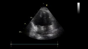 эхокардиография тромб в сердце