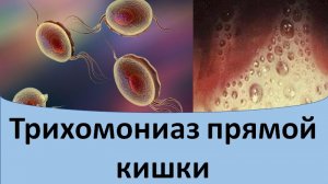 Трихомониаз в прямой кишке.