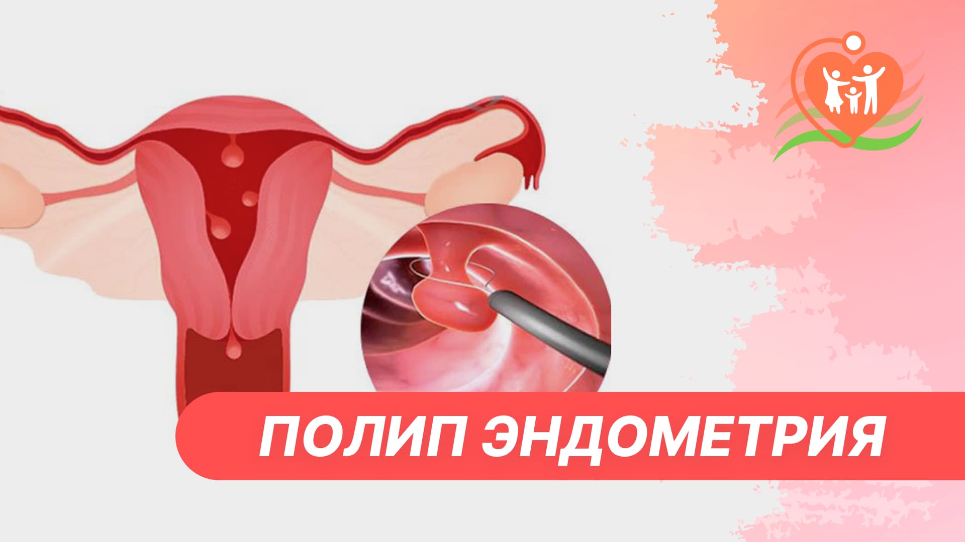 ? Полип эндометрия